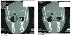 wilson orbital xray fake